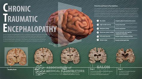 Bubba Smith death 2011 CTE chronic traumatic encephalopathy NFL brain disease